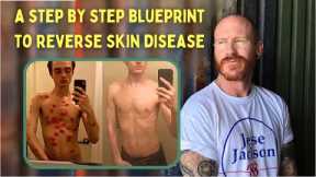 Revealing the complete step by step BLUEPRINT for permanent eczema, psoriasis, dermatitis reversal